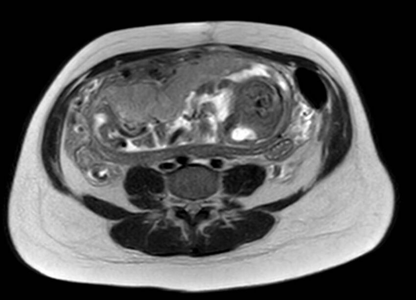 Appendicitis in gravida (MRI) (Radiopaedia 89433-106395 Axial T2 42).jpg
