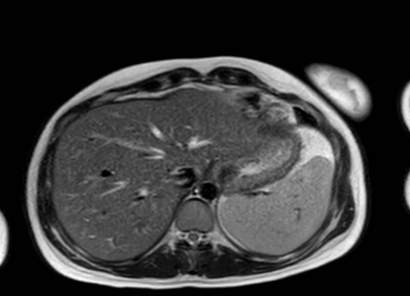 File:Appendicitis in gravida (MRI) (Radiopaedia 89433-106395 Axial T2 7).jpg