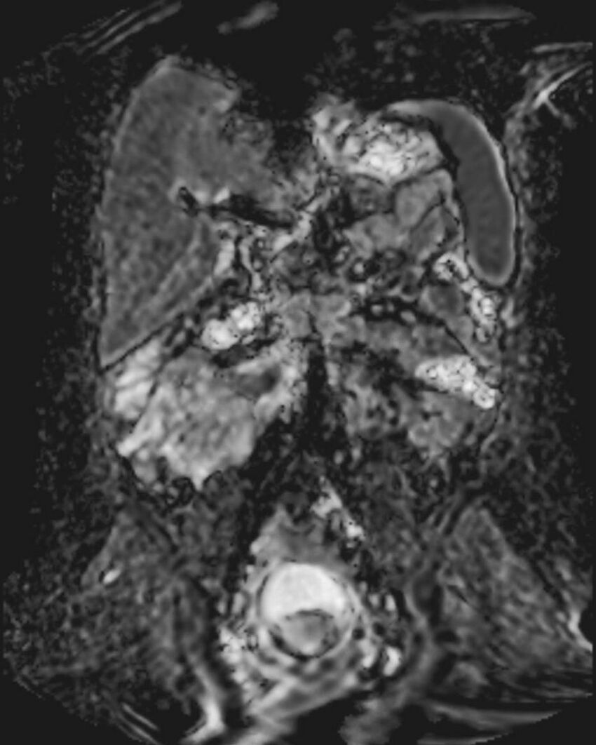 Appendicitis in gravida (MRI) (Radiopaedia 89433-106395 Coronal ADC 31).jpg