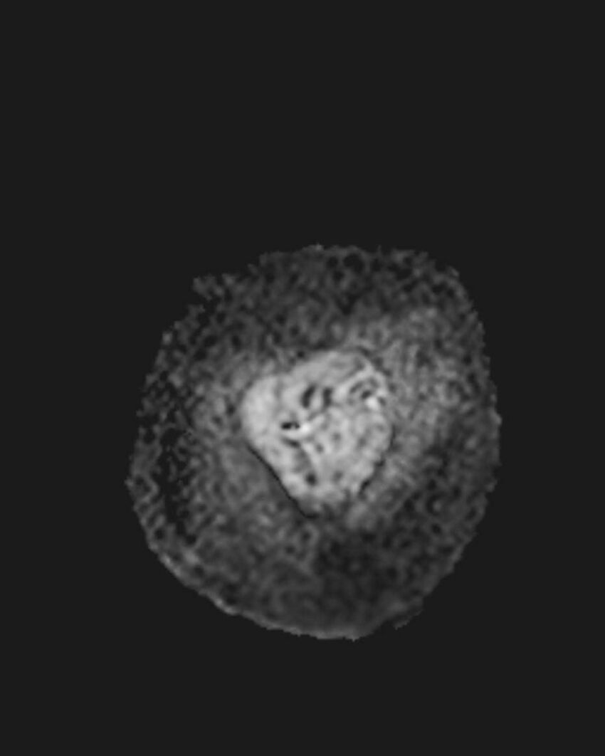 Appendicitis in gravida (MRI) (Radiopaedia 89433-106395 Coronal ADC 7).jpg