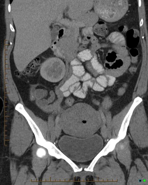 File:Appendicitis post recent cesarian section (Radiopaedia 29594-30102 D 15).jpg