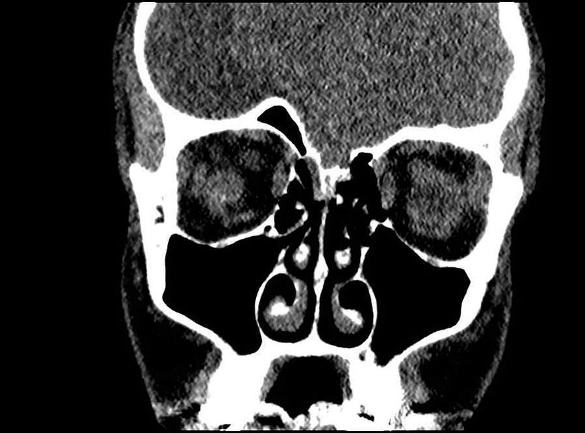 Arachnoid cyst- extremely large (Radiopaedia 68741-78450 Coronal bone window 52).jpg