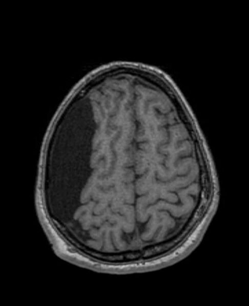 File:Arachnoid cyst- extremely large (Radiopaedia 68741-78451 Axial T1 63).jpg