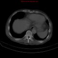 Arachnoiditis ossificans (Radiopaedia 51394-57136 Axial bone window 1).jpg
