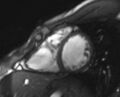 Arrhythmogenic right ventricular cardiomyopathy (Radiopaedia 69564-79464 short axis cine 119).jpg