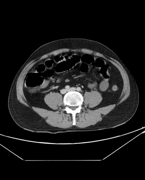 File:Arterial occlusive mesenteric ischemia (Radiopaedia 84641-100054 A 75).jpg