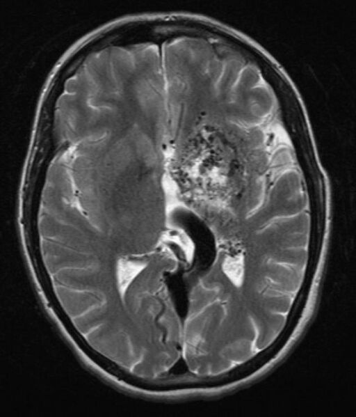 File:Arteriovenous malformation - cerebral (Radiopaedia 36039).jpg