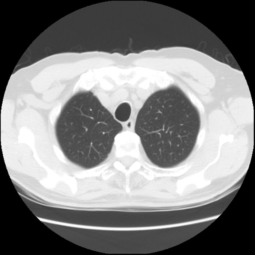 Asbestos-related pleural plaques (Radiopaedia 39069-41255 Axial lung window 12).jpg