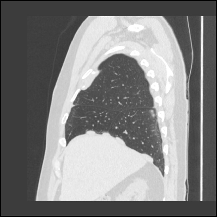 Asbestosis (Radiopaedia 45002-48961 Sagittal lung window 109).jpg