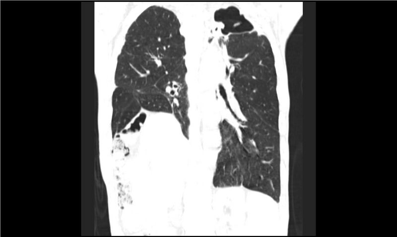 File:Aspergilloma (Radiopaedia 20788-20701 Coronal lung window 11).jpg