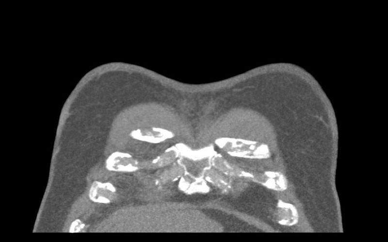 File:Aspirated tooth (Radiopaedia 28584-28844 Coronal C+ CTPA 6).jpg