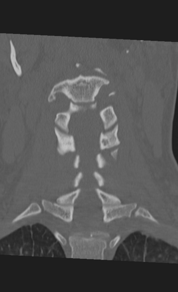 File:Atlanto-occipital dissociation (Radiopaedia 33848-35013 Coronal bone window 22).png