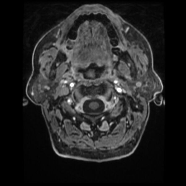 File:Atypical meningioma (Radiopaedia 45535-49629 Axial T1 C+ 9).jpg