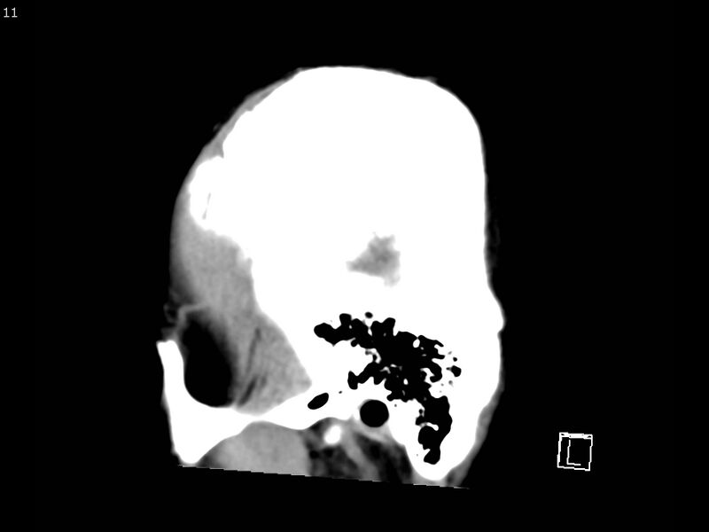 File:Atypical meningioma - intraosseous (Radiopaedia 64915-73867 C 9).jpg