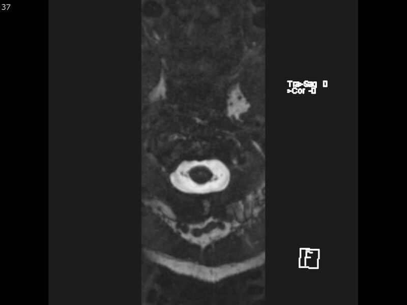 File:Atypical meningioma - intraosseous (Radiopaedia 64915-74572 Axial CISS 37).jpg