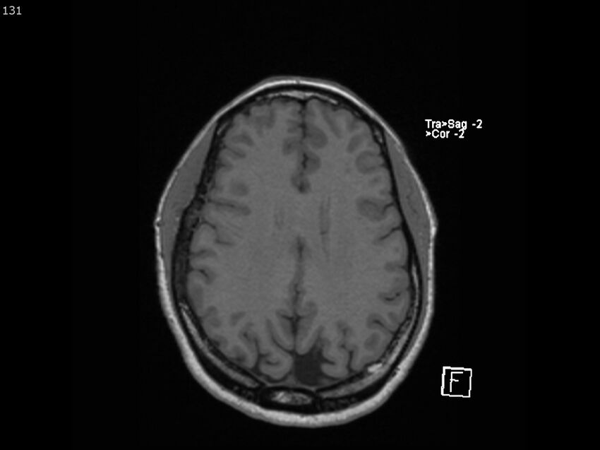 Atypical meningioma - intraosseous (Radiopaedia 64915-74572 Axial T1 131).jpg