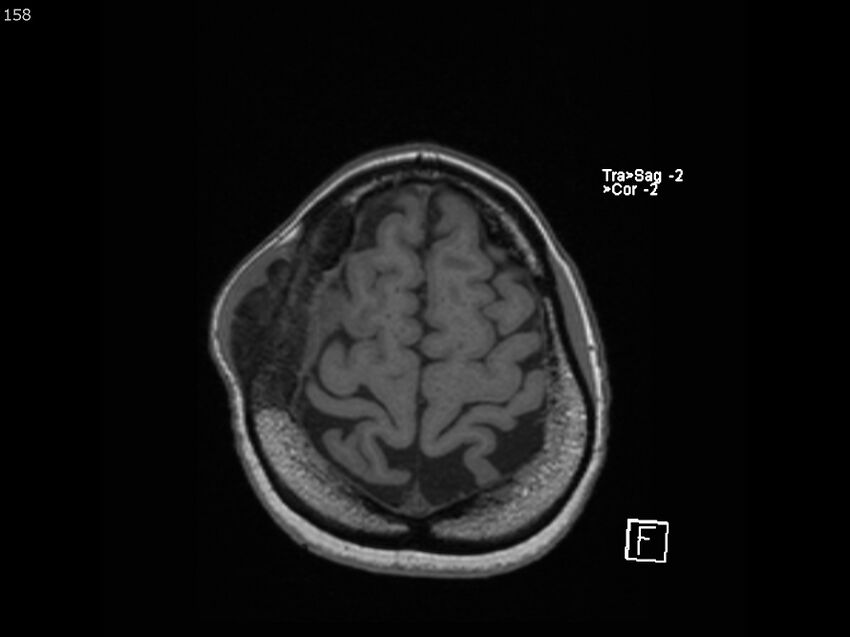 Atypical meningioma - intraosseous (Radiopaedia 64915-74572 Axial T1 158).jpg