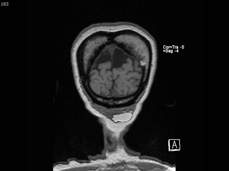 File:Atypical meningioma - intraosseous (Radiopaedia 64915-74572 Coronal T1 183).jpg