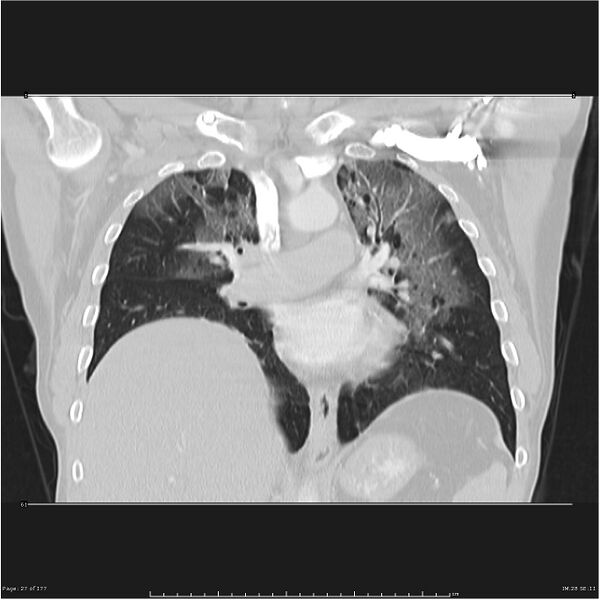 File:Atypical pneumonia - Q fever (Radiopaedia 21993-21989 C 20).jpg