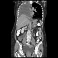 Atypical retroperitoneal lymphocoeles with large leiomyoma of uterus (Radiopaedia 32084-33024 B 13).jpg