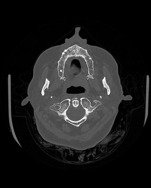 File:Automastoidectomy with labyrinthine fistula (Radiopaedia 84143-99411 Axial non-contrast 36).jpg