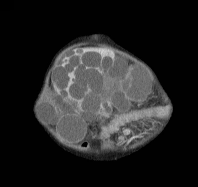 File:Autosomal dominant polycystic kidney disease (Radiopaedia 16777-16490 B 1).jpg