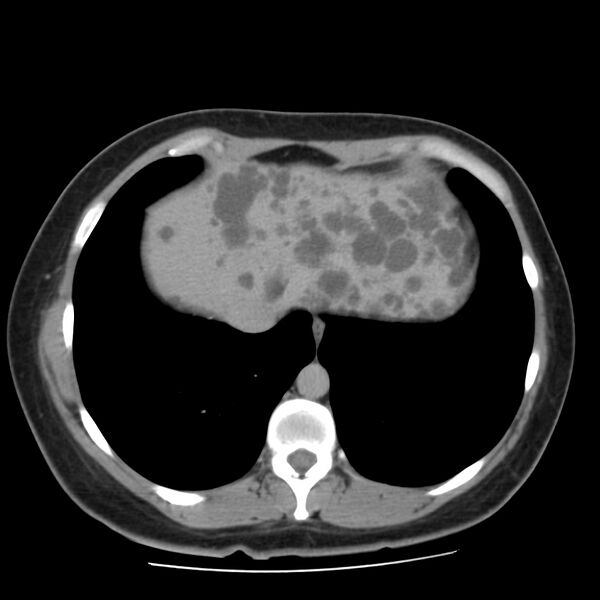 File:Autosomal dominant polycystic kidney disease (Radiopaedia 23061-23093 C+ delayed 7).jpg
