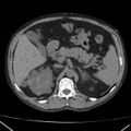 Autosomal dominant polycystic kidney disease (Radiopaedia 36539-38101 Axial non-contrast 26).jpg