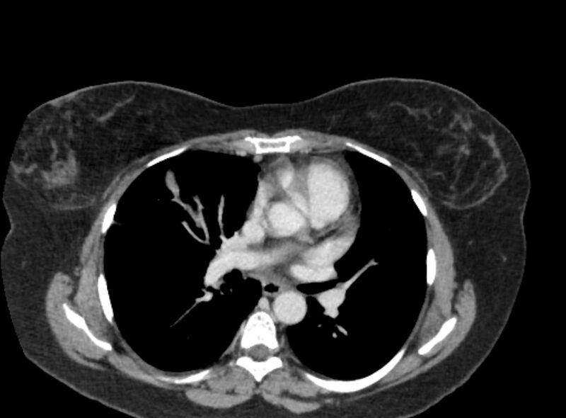 File:Autosomal dominant polycystic kidney disease (Radiopaedia 57124-64017 A 1).jpg