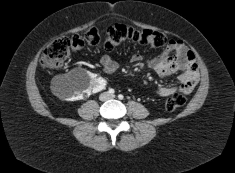 File:Autosomal dominant polycystic kidney disease (Radiopaedia 57124-64017 A 70).jpg