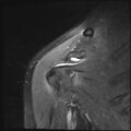 Avulsion fracture - greater tuberosity of humerus (Radiopaedia 71216-81515 Coronal PD fat sat 15).jpg