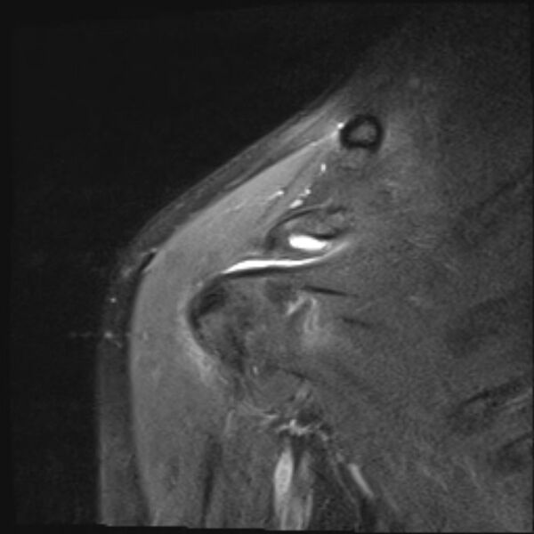 File:Avulsion fracture - greater tuberosity of humerus (Radiopaedia 71216-81515 Coronal PD fat sat 15).jpg