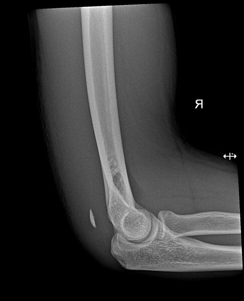 File:Avulsion of the triceps tendon (Radiopaedia 42919-46152 Lateral 1).jpg