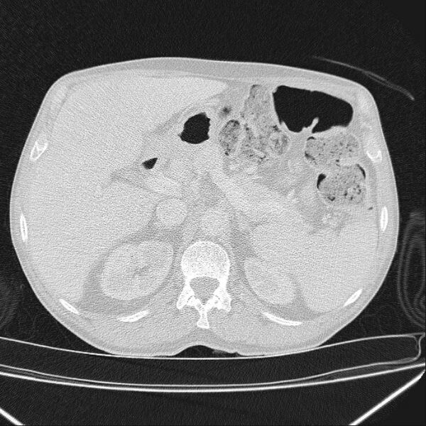 File:Azygos lobe (Radiopaedia 38259-40275 Axial lung window 88).jpg
