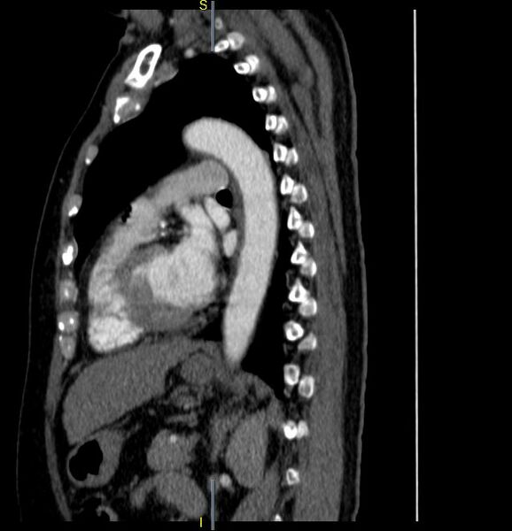 File:Azygos vein aneurysm (Radiopaedia 77824-90130 D 14).JPG