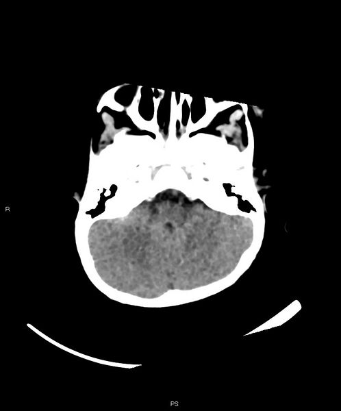 File:Basal ganglia and parenchymal ischemia (Radiopaedia 45818-50083 Axial non-contrast 36).jpg