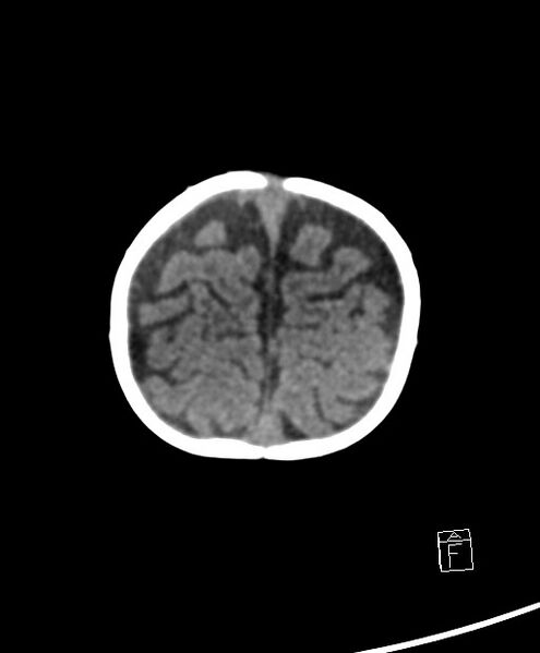 File:Benign enlargement of subarachnoid spaces in infancy (BESS) (Radiopaedia 87459-103795 Axial non-contrast 11).jpg