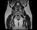 Bicornuate bicollis uterus (Radiopaedia 61626-69616 Coronal T2 25).jpg