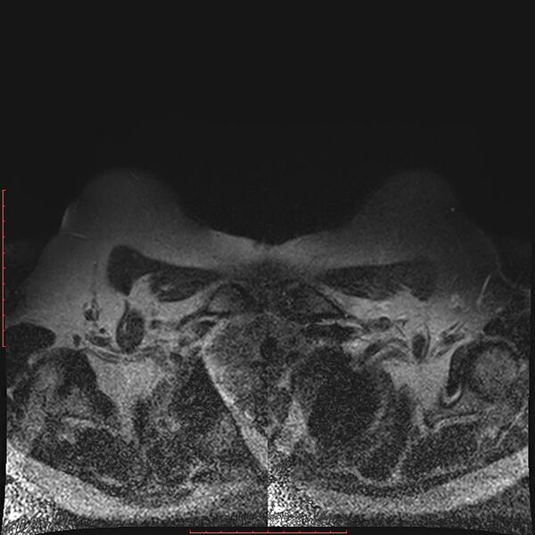 File:Bilateral breast implant rupture (Radiopaedia 24761-25027 T2 fat sat 2).jpg