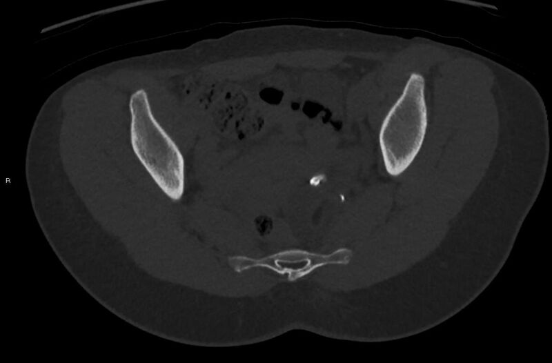 File:Bilateral mature cystic ovarian teratoma (Radiopaedia 88821-105592 Axial bone window 18).jpg