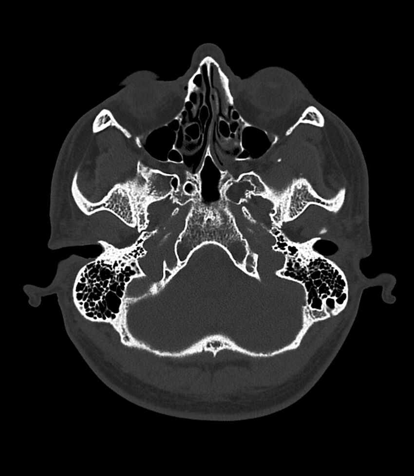 Bilateral medial canal fibrosis (Radiopaedia 85598-101344 Axial bone window 4).jpg