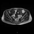 Bilateral ovarian fibroma (Radiopaedia 44568-48293 Axial T2 11).jpg