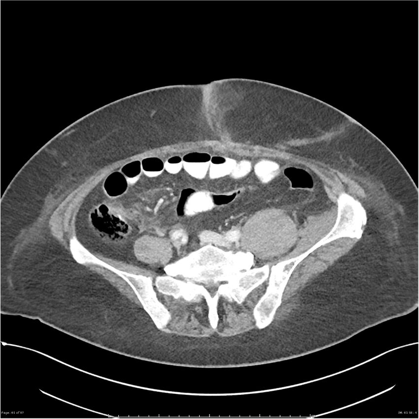 Bilateral psoas hematomas (Radiopaedia 24057-24279 A 61).jpg