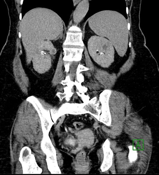 File:Bilateral sporadic synchronous clear cell renal cell carcinoma (Radiopaedia 85035-100575 I 43).jpg