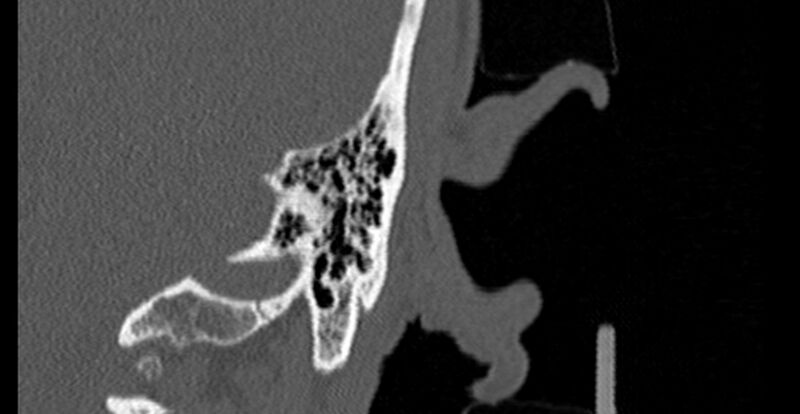 File:Bilateral temporal bone fractures (Radiopaedia 29482-29970 B 89).jpg
