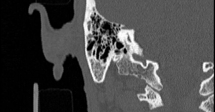 Bilateral temporal bone fractures (Radiopaedia 29482-29970 Coronal non-contrast 147).jpg
