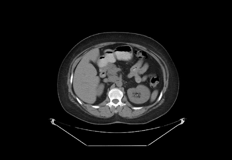 File:Bilateral urolithiasis with incidentally detected splenic artery aneurysm and left inferior vena cava (Radiopaedia 44467-48123 Axial non-contrast 16).jpg