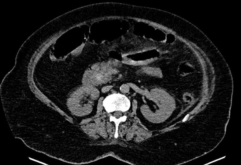 File:Biliary pancreatitis (Radiopaedia 72289-82823 Axial non-contrast 121).jpg