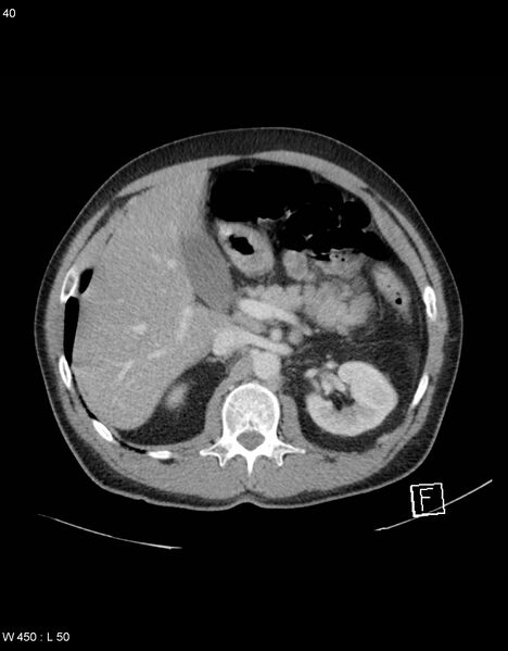 File:Boerhaave syndrome with tension pneumothorax (Radiopaedia 56794-63603 A 20).jpg