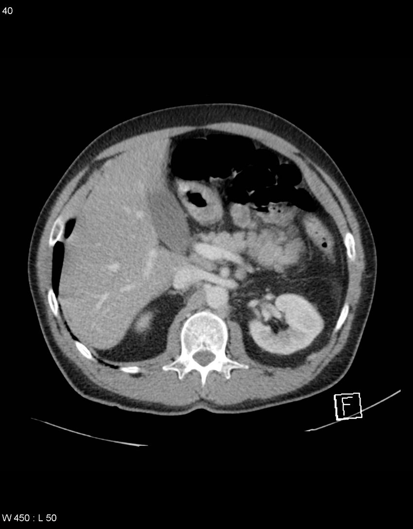 Boerhaave syndrome with tension pneumothorax (Radiopaedia 56794-63603 A 20).jpg